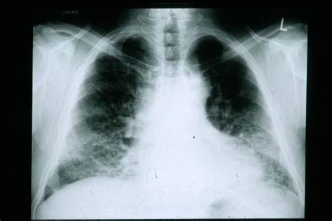 Bibasilar Atelectasis: Causes, Symptoms and Treatment