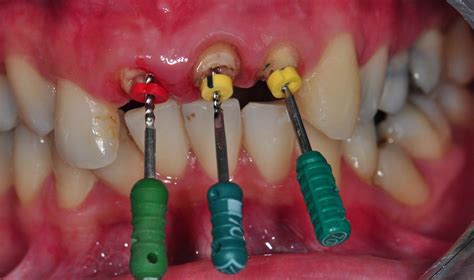 Front Tooth Root Canal