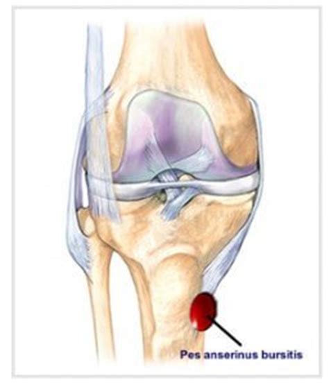 Pes Anserine Bursitis - Causes, Symptoms, Treatment and Prognosis