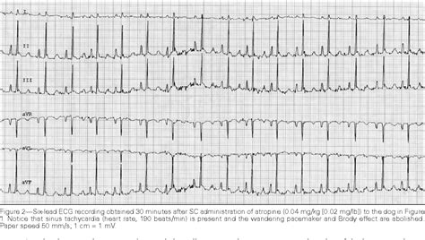 wandering atrial pacemaker ecg - Captions Editor