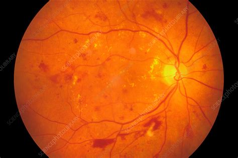 Diabetic retinopathy, fundus image - Stock Image - C034/5900 - Science ...