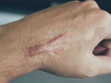 Scar tissue: Causes, prevention, and treatment