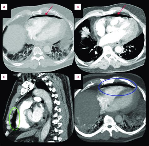 Computed tomography angiogram of the chest showing pneumopericardium... | Download Scientific ...