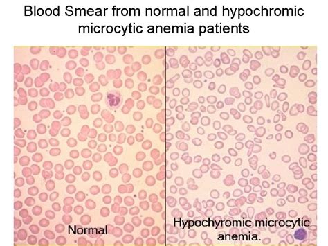 Blood Erythrocytes RBC Blood Smear with Erythrocytes Red