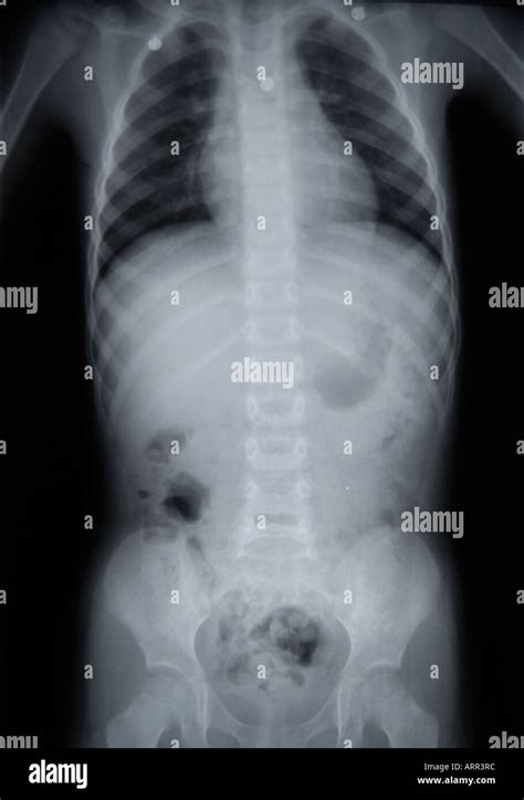 X-ray of pediatric chest abdomen and pelvis Stock Photo - Alamy