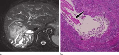 Mass-forming cholangiocarcinoma in a patient with clonorchiasis. (a)... | Download Scientific ...