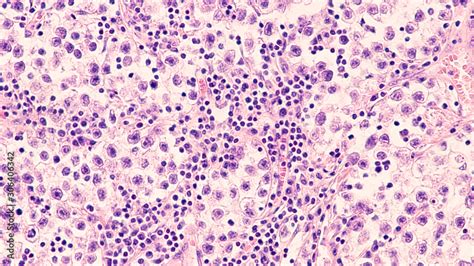 Testicular Cancer: Photomicrograph of seminoma, a malignant germ cell ...