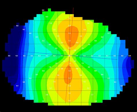 Topography - Keratoconus Contact Lens Fitting