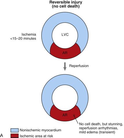 Reperfusion Injury: Prevention and Management | Thoracic Key