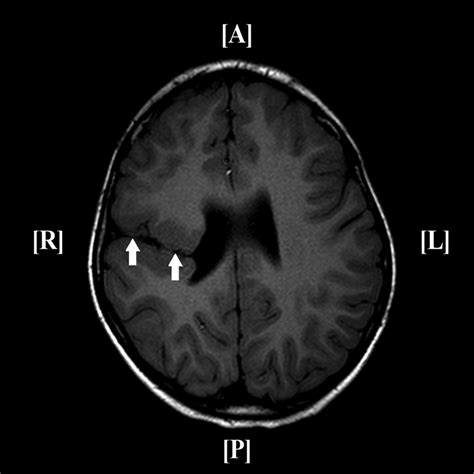 Open Vs Closed Lip Schizencephaly Radiology | Sitelip.org