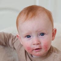 Milk Allergies in Babies | Signs & Symptoms