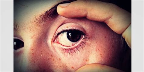 Causes of Eye Flu | Eye Flu Prevention | How Can I Control My Eye Flu?