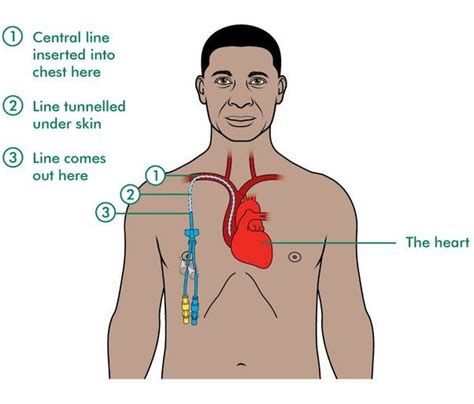 HICKMAN CATHETERS INSERTION. Hickman catheters (Hickman Lines)… | by Dem Ebs Backoffice | Aug ...