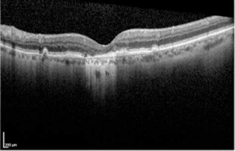 Age-Related Macular Degeneration: From One Medical Student to Another ...