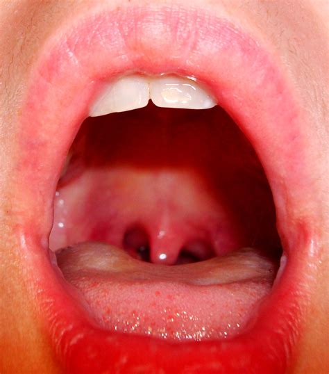 Tonsils | You see how you can see the back of my throat? You… | Flickr