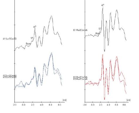 ECOG -- electrocochleography