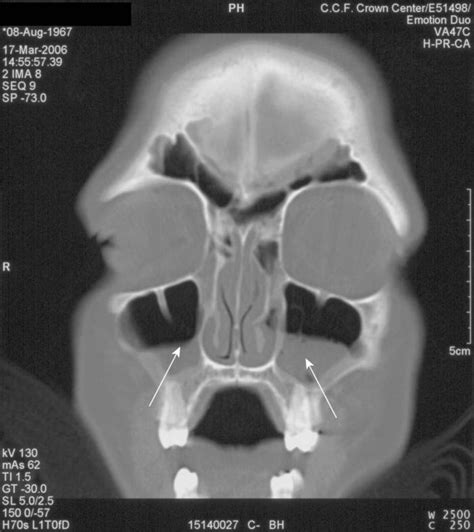 Sinusitis