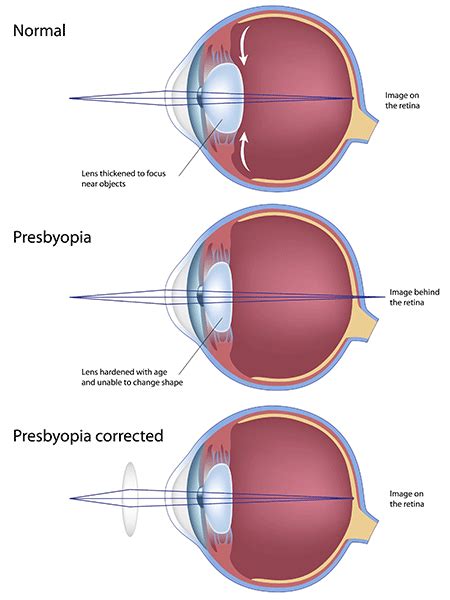 Presbyopia | Jamison Optical