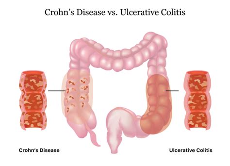 Ulcerative Colitis: Symptoms, Causes, Diagnosis Treatment, 41% OFF