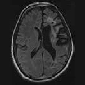 MRI brain showing large area of gliosis in left frontoparietal region... | Download Scientific ...