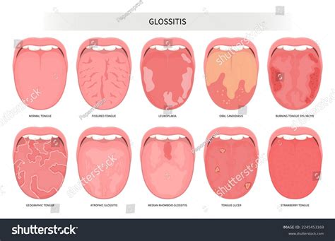 26 Median Rhomboid Glossitis Images, Stock Photos, and Vectors | Shutterstock