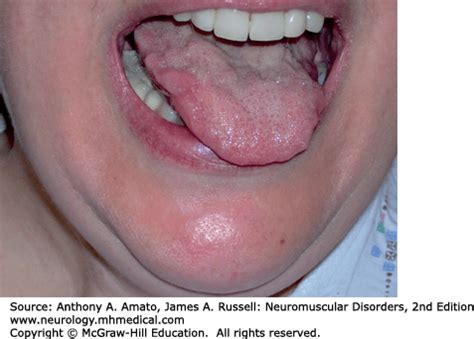 Amyotrophic Lateral Sclerosis | Neupsy Key