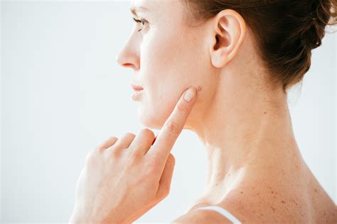 Everything You Need to Know About Mole Removal