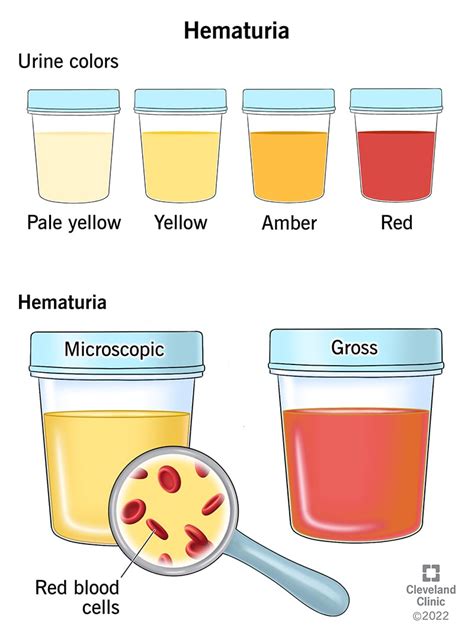 Understanding Occult Blood in Urine: Causes, Symptoms, and Treatment ...