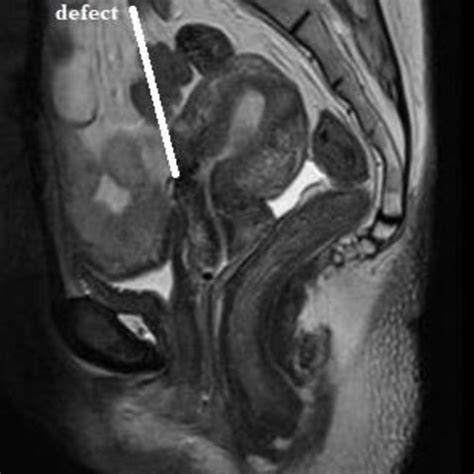 MRI pelvis (contrast)-retroverted uterus with a focal semicircular... | Download Scientific Diagram