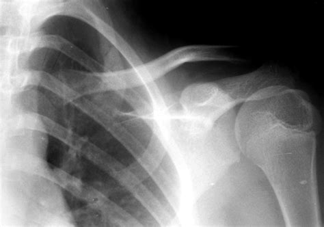 Two cases of isolated first rib fracture | Emergency Medicine Journal