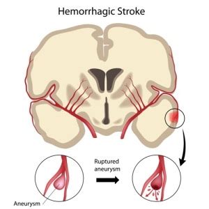 Hemorrhagic Stroke - Net Health Book