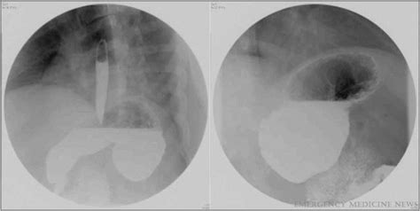 Stomach Volvulus; Volvulus, Stomach; Gastric Volvulus