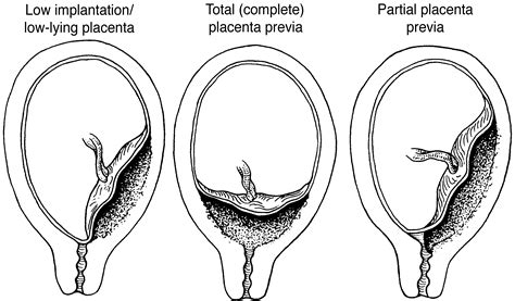 Placenta Accreta Mri