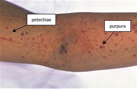 Disseminated intravascular coagulation causes, signs, symptoms, diagnosis & treatment