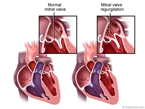 Mitral Valve Disease Diagnosis And Treatment Mayo Clinic, 56% OFF