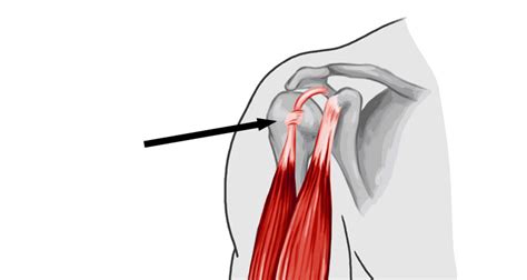 Long Head of Biceps Rupture - Symptoms, Causes and Treatment.