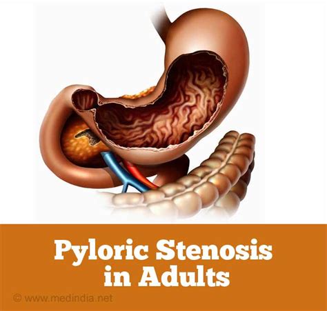 Pyloric Stenosis in Adults - Causes Symptoms Signs Diagnosis Treatment