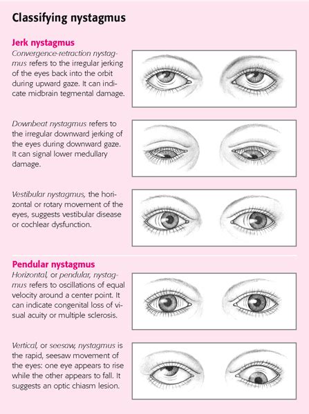 Nistagmo: sintomas, causas, diagnóstico, tratamento - Olho-Saúde 2024