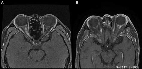 Frontiers | Optic Perineuritis and Its Association With Autoimmune Diseases