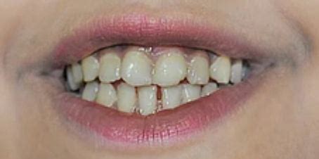 Press On Veneers Before and After - Photo Gallery – TruSmile Veneers