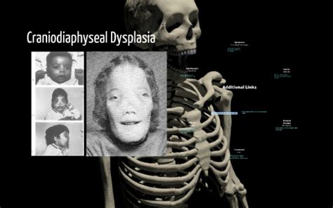 Craniodiaphyseal Dysplasia Skull