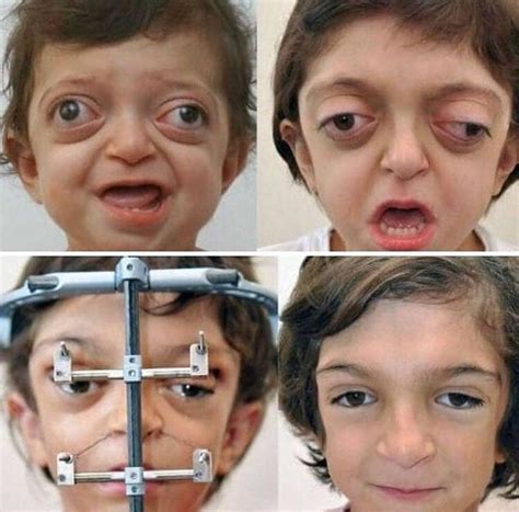 Facial reconstruction on a child with Crouzon Syndrome : r/pics