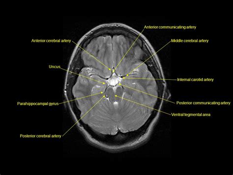 Parahippocampal Gyrus Mri