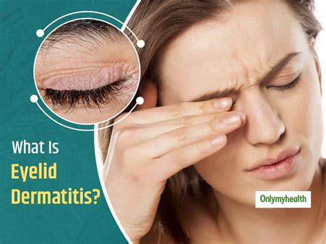 Eyelid Dermatitis or Dry Eyelids Is A Common Problem, Tackle It With ...