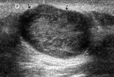 Subcutaneous Dermoid Cyst Ultrasound