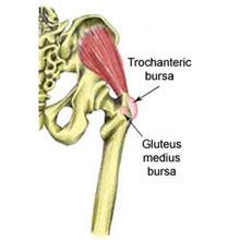 Synovitis of the Hip | Symptoms, causes & treatment explained