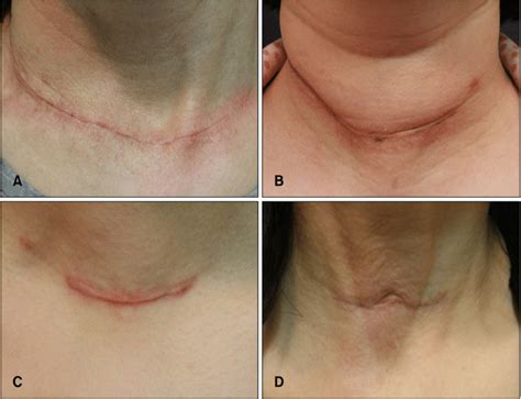 Classification of postthyroidectomy scars. (A) Linear flat scar. (B)... | Download Scientific ...