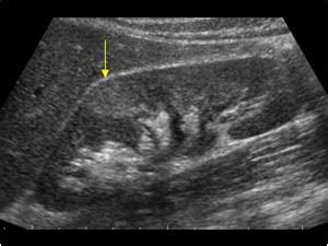 Urinary Tract and male reproductive system | 2.1 Kidney and ureter ...