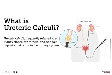 Right Ureteric Calculus Icd 10 Cm Code 2024 C - Alyda Moreen