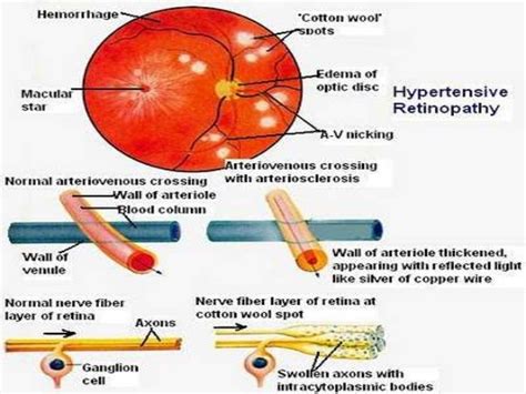 Hypertension and ocular changes